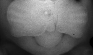 Studying the genetic causes of cleft lip and cleft palate
